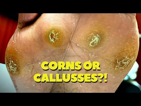 THICK, DEEP Seeded Corn and Callus Removal
