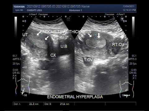 Endometrial Hyperplasia, patient aged 36 years, married having three children.
