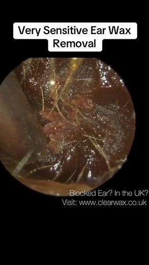 Expert Ear Wax Removal Techniques for Sensitive Ears