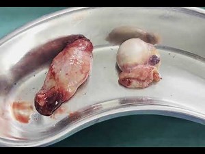 Orchiectomy | Bilateral Orchiectomy | Testis Removal In Prostate Cancer