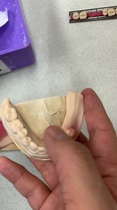 Upper and Lower Acrylic Partials. Case from Dr. Manuel Pazmino in Texas. EnvisionTEC Pazmino Dentistry | LSK121 Oral Prosthetics