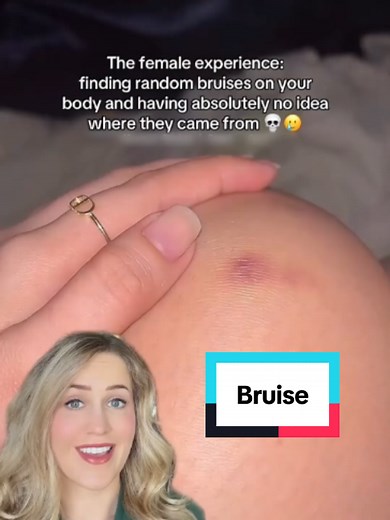 Unexplained Bruises: Causes, When to Seek Help, and Treatment