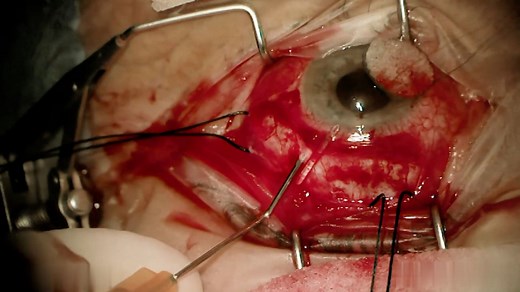 Baerveldt drainage device insertion for refractory glaucoma - Mayo Clinic
