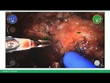 Robotic-Assisted Radical Prostatectomy Using Versius • Video • MEDtube.net