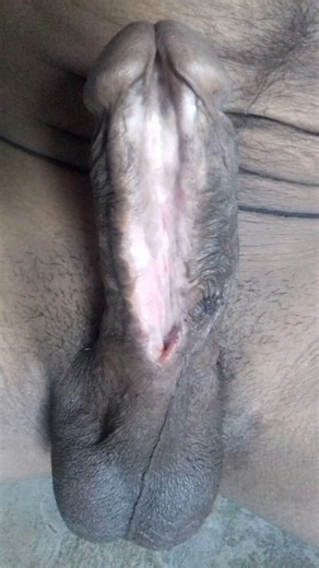 Full subincision - video 3