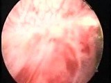 Hysteroscopic Treatment Of Intr Uterine Endometrial Polyp • Video • MEDtube.net