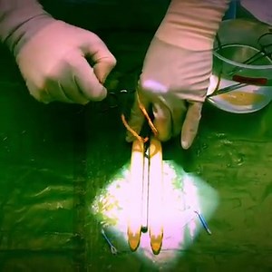 Inflatable penile implants can improve the length and girth of the penis. This demonstration shows how penile implants work. www.healthy-male.com. #penileimplants #penileprosthesis #penileenlargement #penileimplant #bostonscientific #lgx | Dr Edward Karpman, MD, FACS