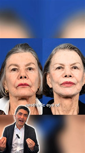 Dr. Babak Azizzadeh is internationally recognized for his advanced deep plane facelift technique, focused on natural-looking rejuvenation. ✅ Advanced deep plane method for refined results ✅ Dual board-certified in Facial Plastic & ENT Surgery ✅ Personalized care in Beverly Hills ✨ Schedule your private consultation today. | Dr. Babak Azizzadeh - Center for Advanced Facial Plastic Surgery