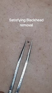 Satisfying Deep-Rooted Blackhead Removal on Back