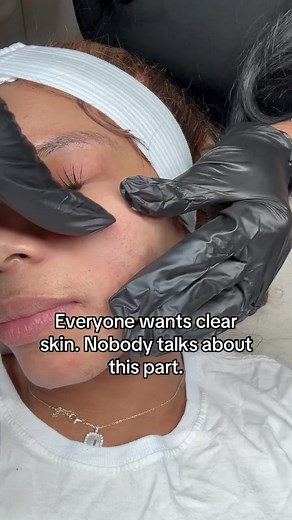 Professional Extractions for Clear Skin: What to Expect