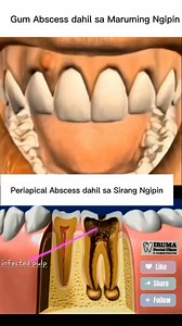 4K views · 21 reactions | Abscess or forming Pus o Pagnanana. #irumadentalclinic #trendingnow #OralHealth #tips #dentalpractice #abscess #dentalcare #dental #dentalhygiene #DentalHealth #oralcare #pov #advice | Iruma Dental Clinic | Facebook
