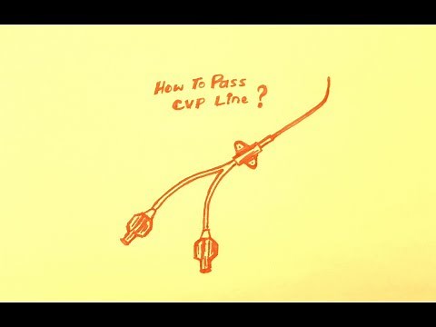 Central Line Catheter Use in Medicine