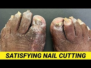 CUTTING OF SUPER THICK, LONG & CRUSTY TOENAILS