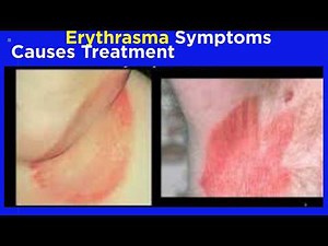 Erythrasma: Symptoms, Causes, Treatment