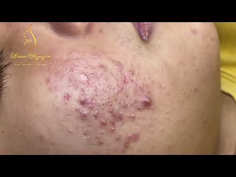 Eliminate many blackheads for customers (335) | Loan Nguyen