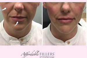 ✔️Lips: 1 syringe Restylane (1 ml) for volume and more definition of the vermillion border (outer lining of lips)⠀ ⠀ ✔️Cheeks: 1 syringe LYFT each side to add volume and lift cheek and thus smooth out nasolabial folds and creases. #chattafaces⠀ ⠀ ⠀ #beauty #antiaging #chattanooga #nooga #sceniccity #downtownchattanooga #chattanoogafun | Affordable Fillers | Facebook