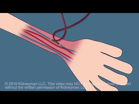 Dialysis Fistula animation