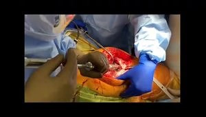 Femoral Stem Extraction using the Watson Extraction System