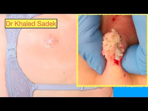 Massive Back Cyst. Dr Khaled Sadek