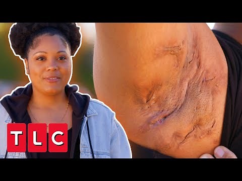 Dr. Lee Treats “Tunnels Under The Skin” (Hidradenitis Suppurativa) | Dr. Pimple Popper