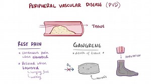 4.5K views · 94 reactions | Peripheral vascular disease (PVD) - causes, symptoms & pathology | Manual of Medicine | Facebook