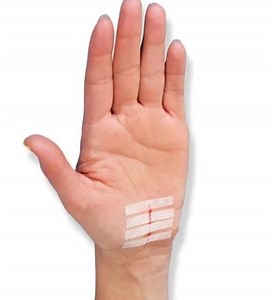 [Hot Item] Medical Skin Adhesive Wound Closure Device