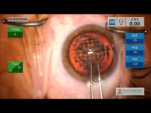 STAAR ICL Removal After Femtosecond Cataract Treatment Followed by Symfony Lens Insertion - Eyetube