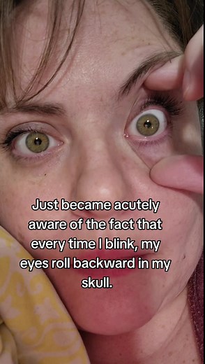 Understanding Astigmatism: Eyes Rolling Back When Blinking