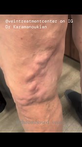 Thrombophlebitis of tributary veins over the knee. If you develop hard, tender veins, seek immediate evaluation for Doppler ultrasound scanning. Superficial vein thrombosis can coexist with deep vein thrombosis. Call 716-839-3638 www.VeinsVeinsVeins.com @veintreatmentcenter #thrombophlebitis | Vein Treatment Center