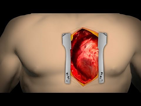 This Is How Open-Heart Surgery Is Performed