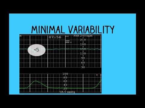 Topic 26: Intrapartum Fetal Surveillance