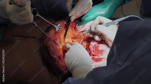 Surgical operation abdominoplasty. Close-up of the patient on the operating table, surgical removal of fat tissue from the abdomen.
