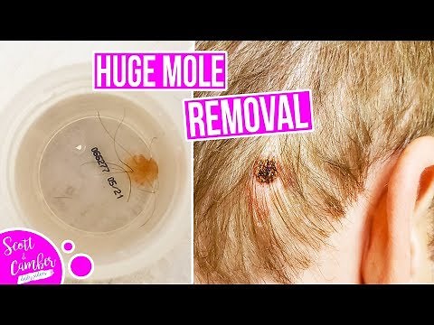 HUGE MOLE REMOVAL!! HEAD MOLE REMOVAL SURGERY AND LASER TREATMENT