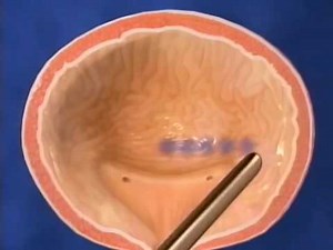 Bladder Botox Injections, Steinberg Urology Montreal