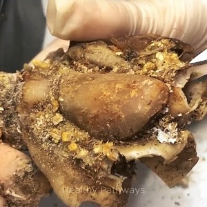 Healthy Nails, Fixing Curling Toenails and Onychomycosis | Healthy Pathways