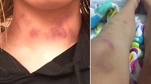 Photos Allege to Show Bruising Caused by Matt Araiza, SDSU Teammates' Gang Rape