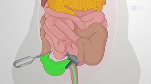 Video: Segmental Adeno-Cre Infection: A Technique to Generate Isolated Colorectal Cancer using Genetically Engineered Mouse Models - Experiment
