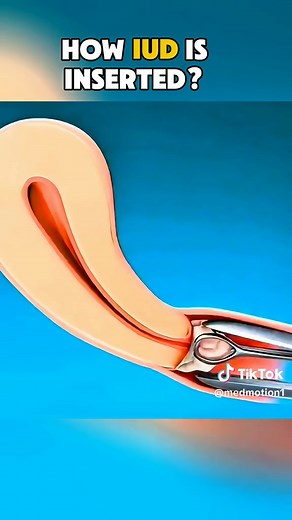 IUD Insertion Explained with 3D Animations