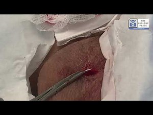 No Needle No Scalpel Vasectomy in San Antonio, Texas with Dr Kella. Step by Step Instructions