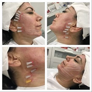 4 comments | Thread Lift PDO just £399 Full Face or £499 Face &...