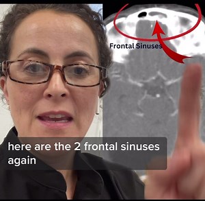 CT of a brain abscess. (Part 2) #CT #sinus #CTscan #momsoffb #sinusitis | Teach Me Doc