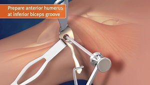 Subpectoral Biceps Tenodesis Repair Utilizing On-Lay, All Suture Anchor Fixation