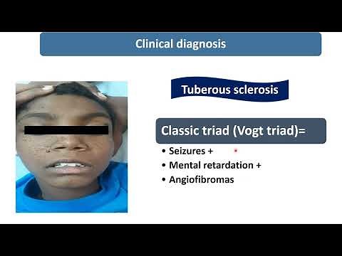 Tuberous Sclerosis || Spot Diagnosis - 8 || Pediatrics