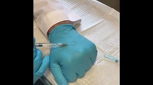 See How Much 1 CC of Juvederm Ultra Plus Is