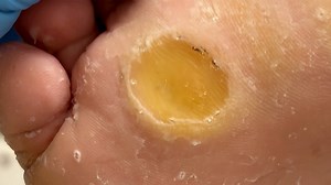 1.3K views · 14 reactions | Treatment of very large calluses | Ingrown toenails | Facebook
