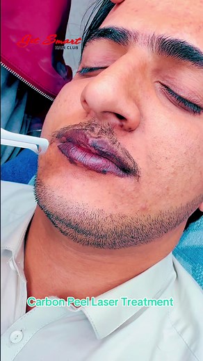 Transform Your Skin with Carbon Peel Laser Treatment
