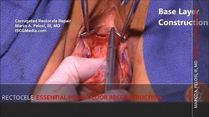 Rectocele Repair: How and Why It's Critical to Your Vaginoplasty (GRAPHIC)
