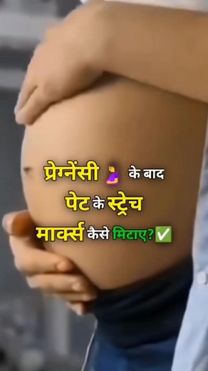 💯🌟How to remove stretch marks from stomach🤰 after pregnancy?💯✅ ✔️✅#stretchmarks #skincare #beauty #cellulite #skin #stretchmarkremoval #scars #selflove #wrinkles #bodypositivity #microneedling #antiaging #pregnancy #acnescars #skintightening #scarremoval #naturalskincare #stretchmark | Ai DigitalHealth