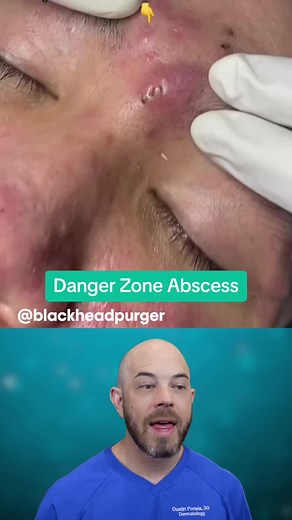 Danger Zone: Understanding Abscess Popping Risks