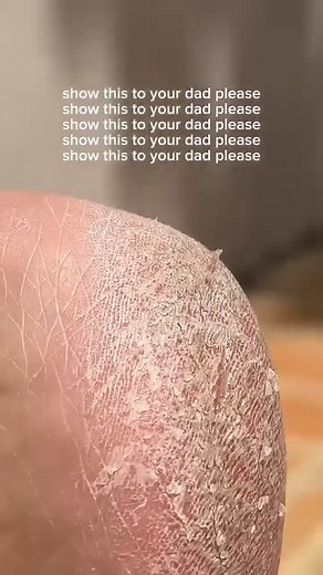 👣 Tired of rough, cracked heels? 👩‍🦳 Perfect gift for mom, dad, or grandparents. ✨ in just 2 mints - remove hard skin instantly and get smooth feet at home! ✨ No salon needed. Portable & rechargeable, Ideal for sensitive skin Cash on Delivery, 30 Days warranty, Hassle free return. 💥 grab Callus Remover at a dreamy discount ( Save RS- 2112! ) before it’s gone! 💫 Now at 2299 ( 4400 ) for a Limited time⏰ at zmhud.com #callusremover #callusremovers #calluses #parents #parentsupport #parentsofte